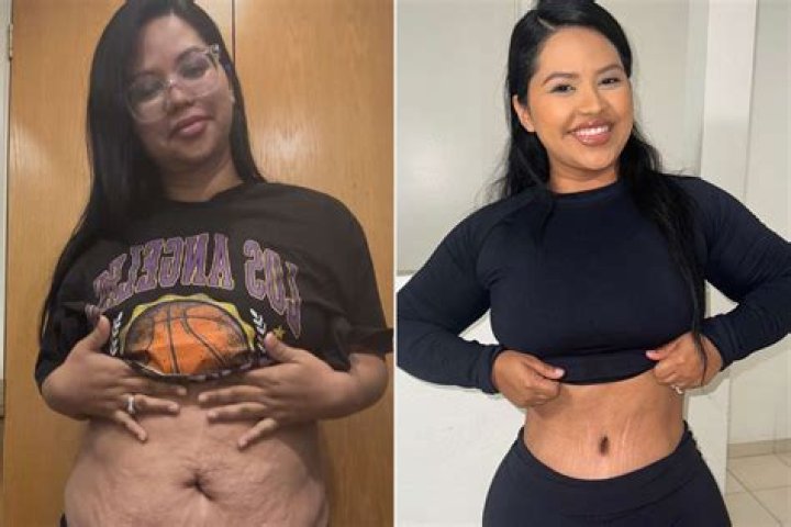 Yung Miami BBL Surgery | Before And After Photos